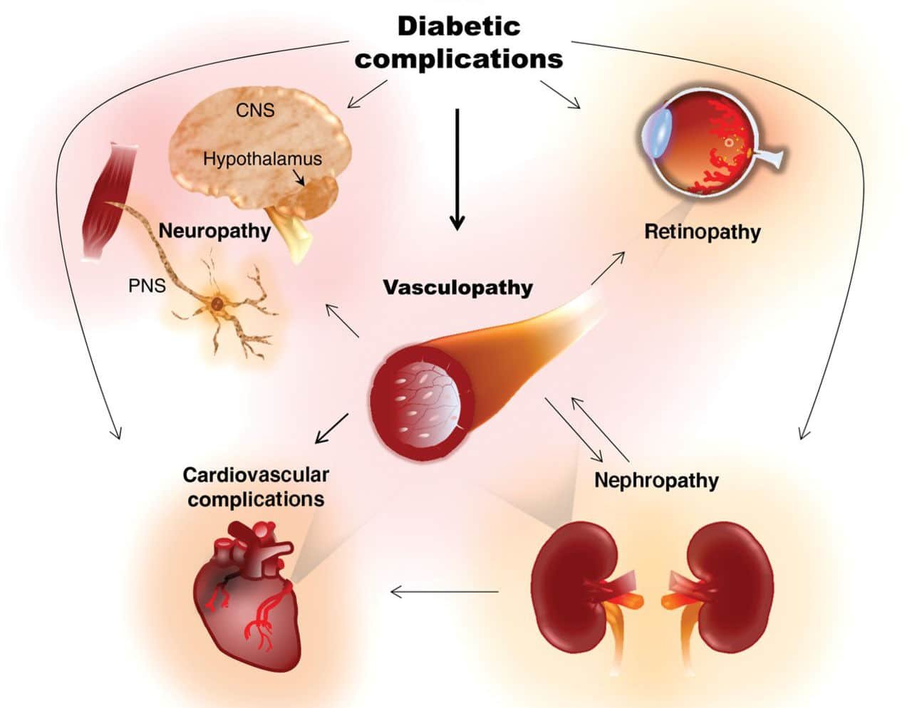 complicanze diabete mellito