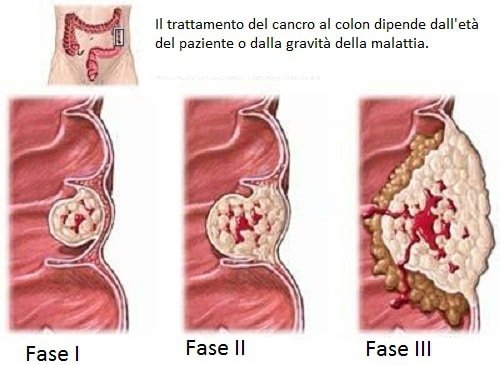 tumore-del-colon-retto