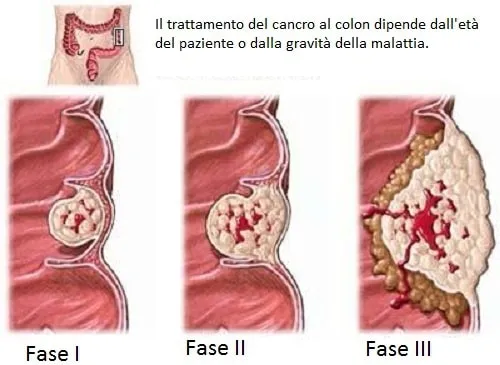 tumore-del-colon-retto