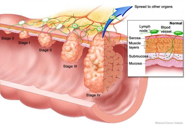 cancro al colon cause