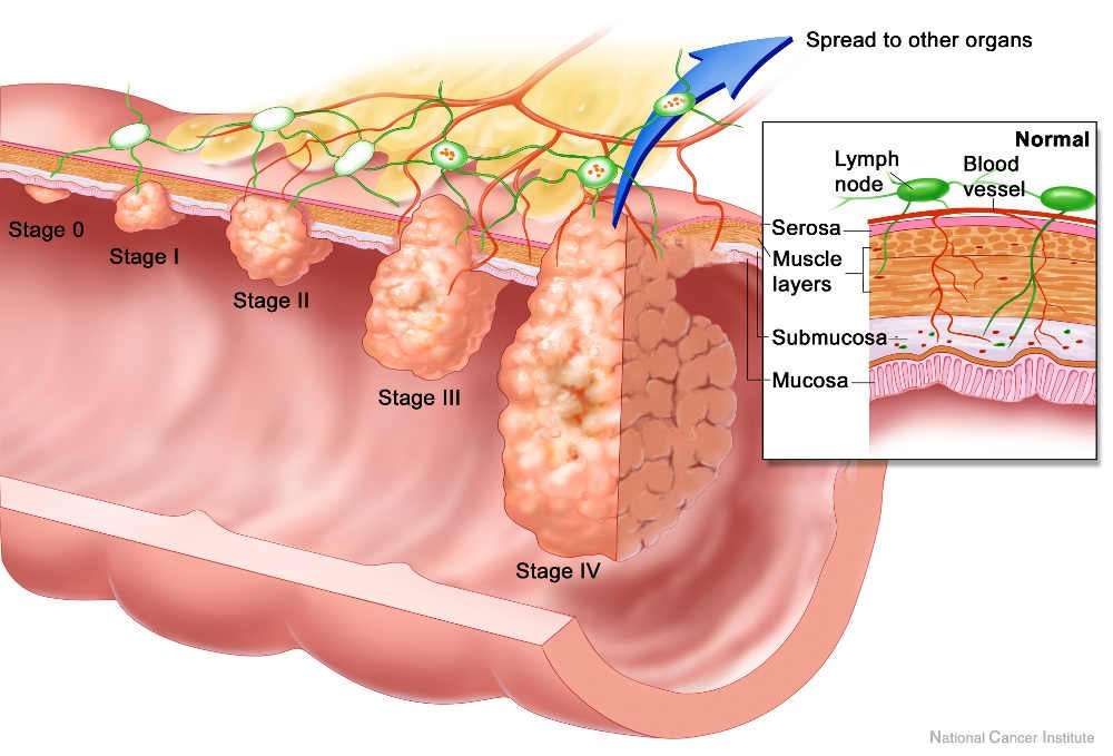 cancro al colon cause