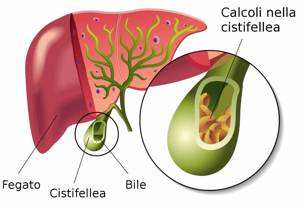 calcoli nella colecisti