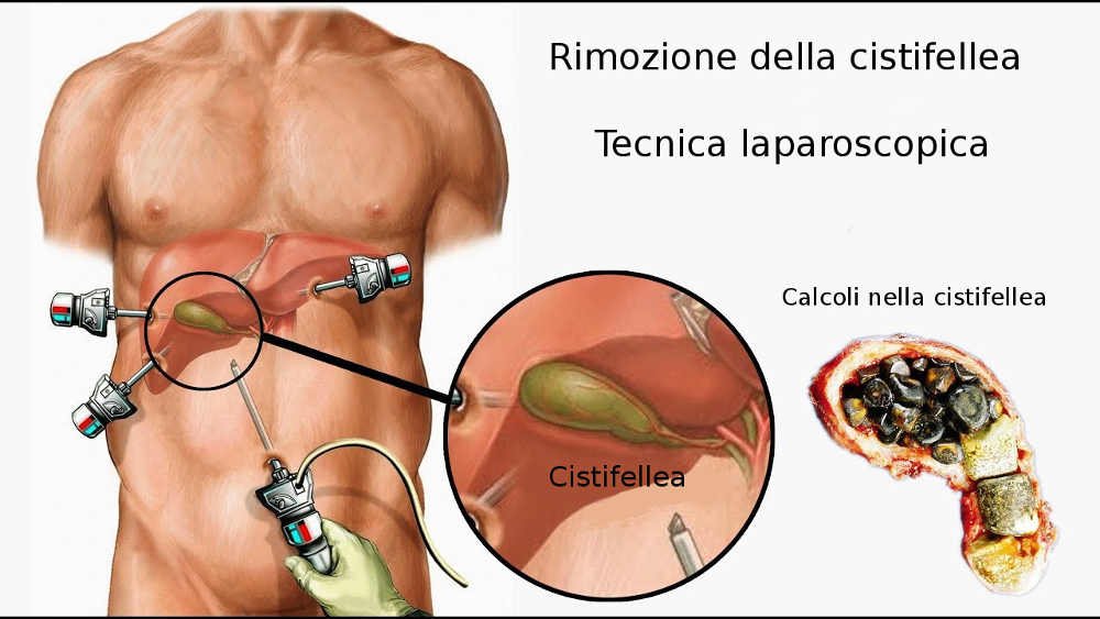 colecistectomia